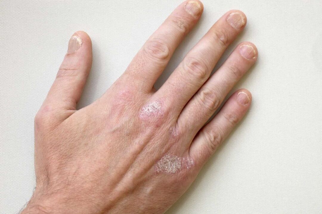 psoriāzes uz vīrieša rokām ārstēšana ar Keramin krēmu