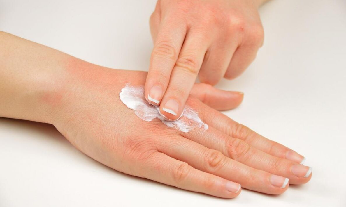 psoriāzes ārstēšana ar Keramin krēmu