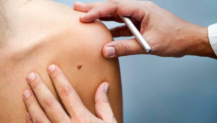 Dermatologs pārbauda pacientu ar papilomu