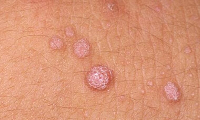 HPV izraisa ādas papilomu parādīšanos