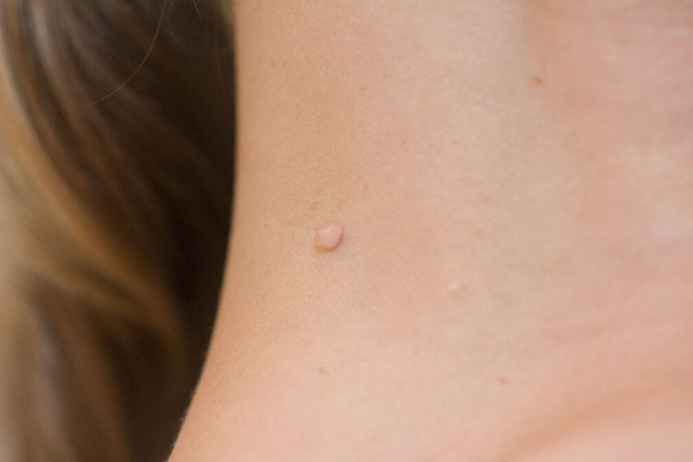 HPV simptomi