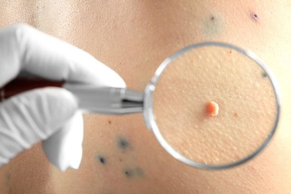 HPV ārstēšana
